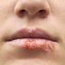 Sintomas, Causas e Tratamento da Herpes
