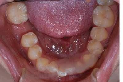  Vậy khắc phục mất răng số 5 như thế nào ?