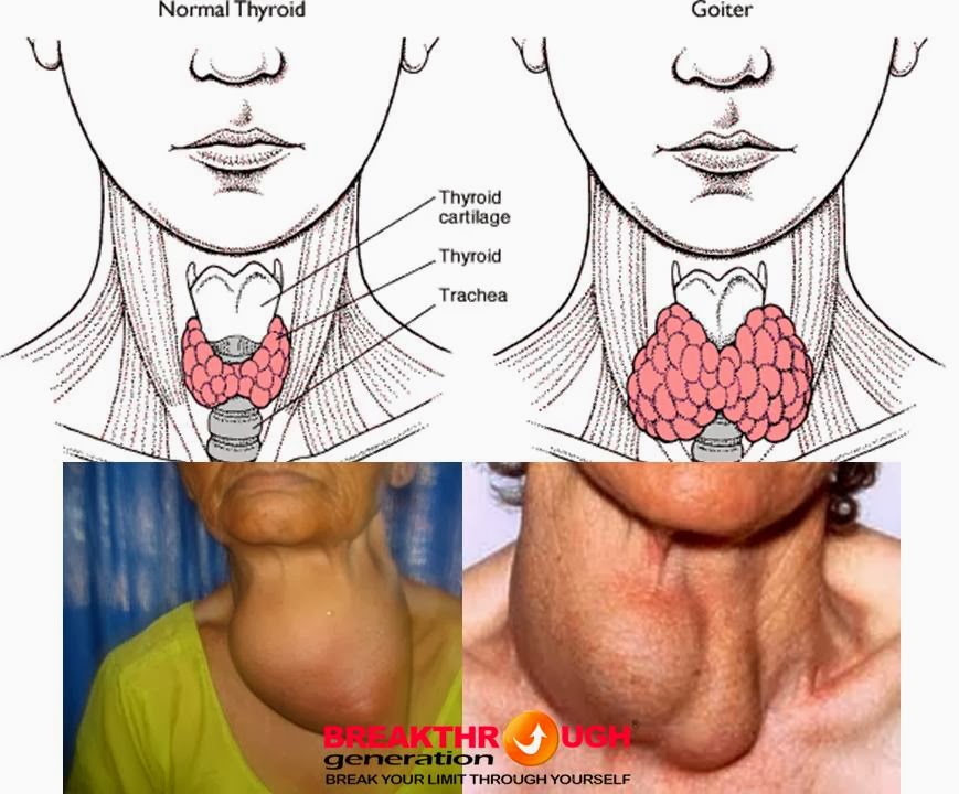 1ST STEP in UNDERSTANDING the BODY STRUMA HIPERTIROID BASEDOW