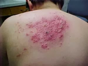 Ada Bintik-Bintik Berair Dan Panas Di Punggung, Apakah Herpes?