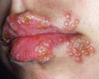 Penyakit Herpes Di Mulut