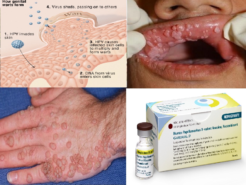 HPV papilomavirus uman)