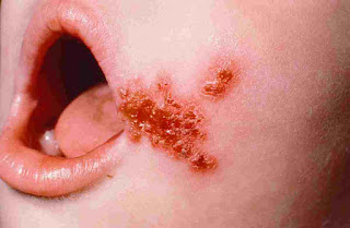 Infantigo Symptoms, Causes, Treatment, Images, Remedies