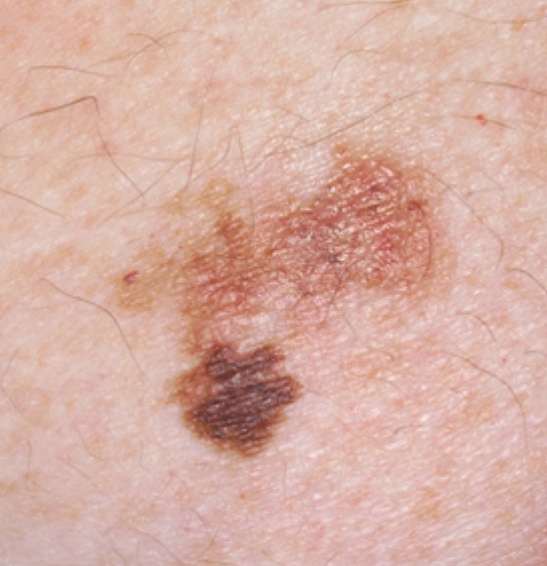 White spots on the skin (with pictures) | Library | SkinVision