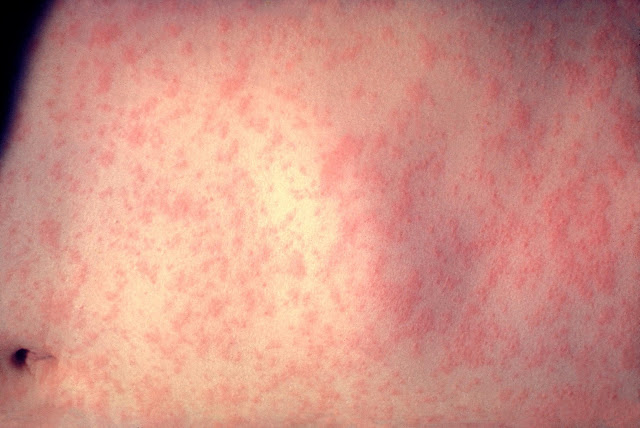 https://upload.wikimedia.org/wikipedia/commons/3/3c/Morbillivirus_measles_infection.jpg