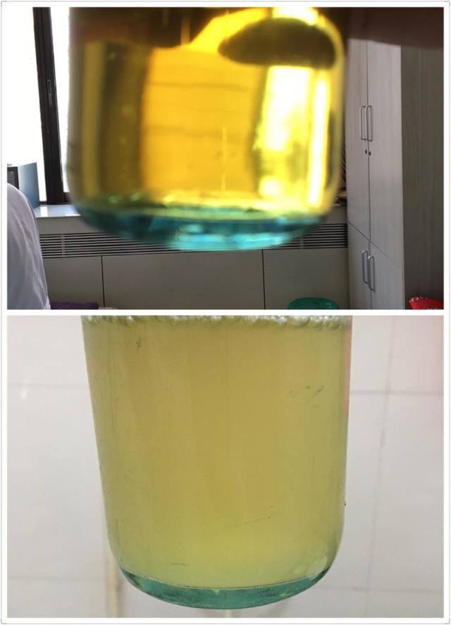 Abnormal Conditions of Bubbles in Urine