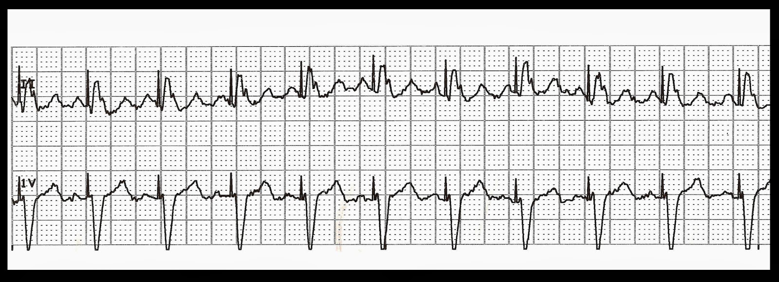 Various Ventricular Paced Rhythms