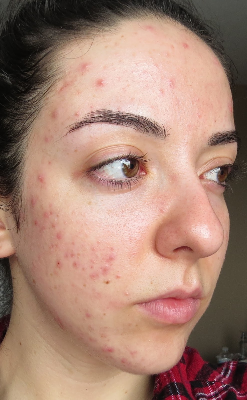 My Skin's Journey : Week 37: Banish Acne Scars