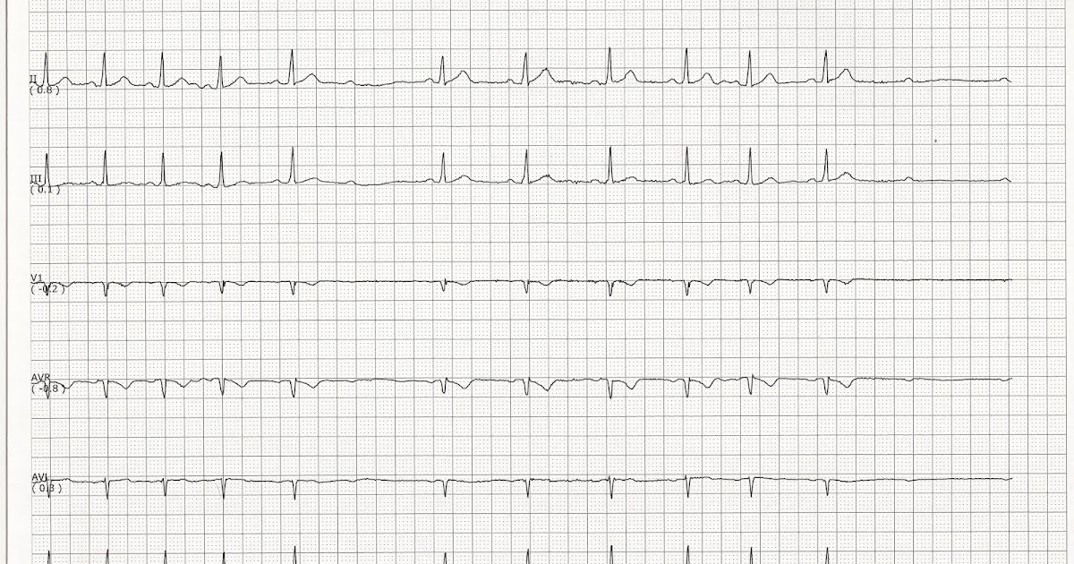 Second degree heart block type II