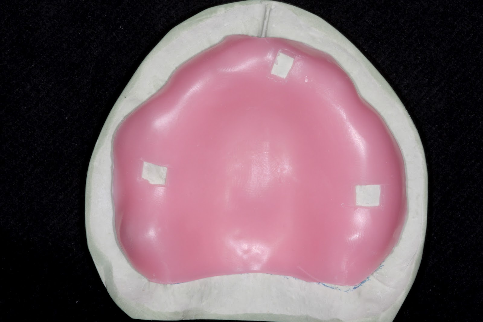 Boise Idaho Prosthodontics: Edentulous Custom Tray for PVS Impression ...
