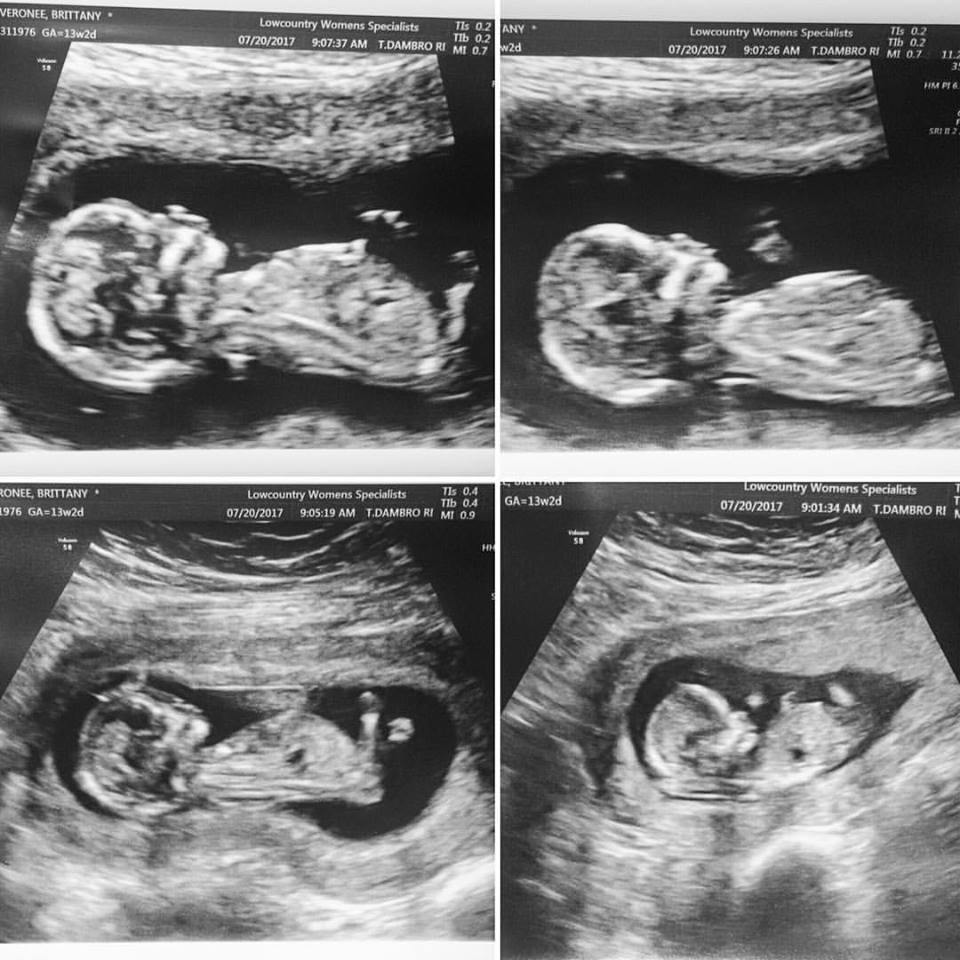 oh-baby-v-13-week-nt-ultrasound