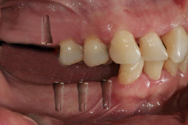 Implante implantologia protesis dientes implantes estetica dentales odontologia diente paciente Unidad Odontologica El Cedro: Implantes Dentales