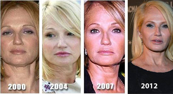 Ellen Barkin Plastic Surgery.