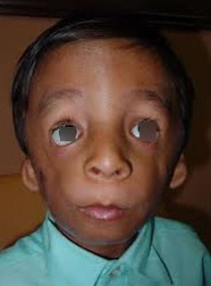 syndrome digeorge anomalies facial dgs