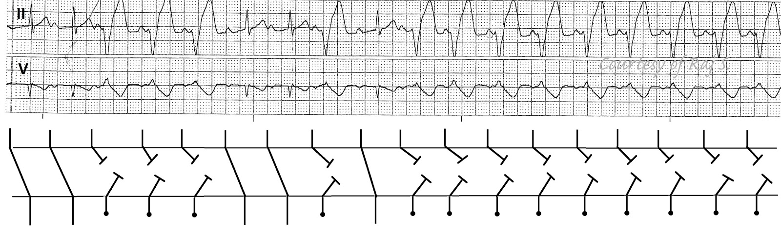 ECG Rhythms Isorhythmic AV dissociation SR + VT