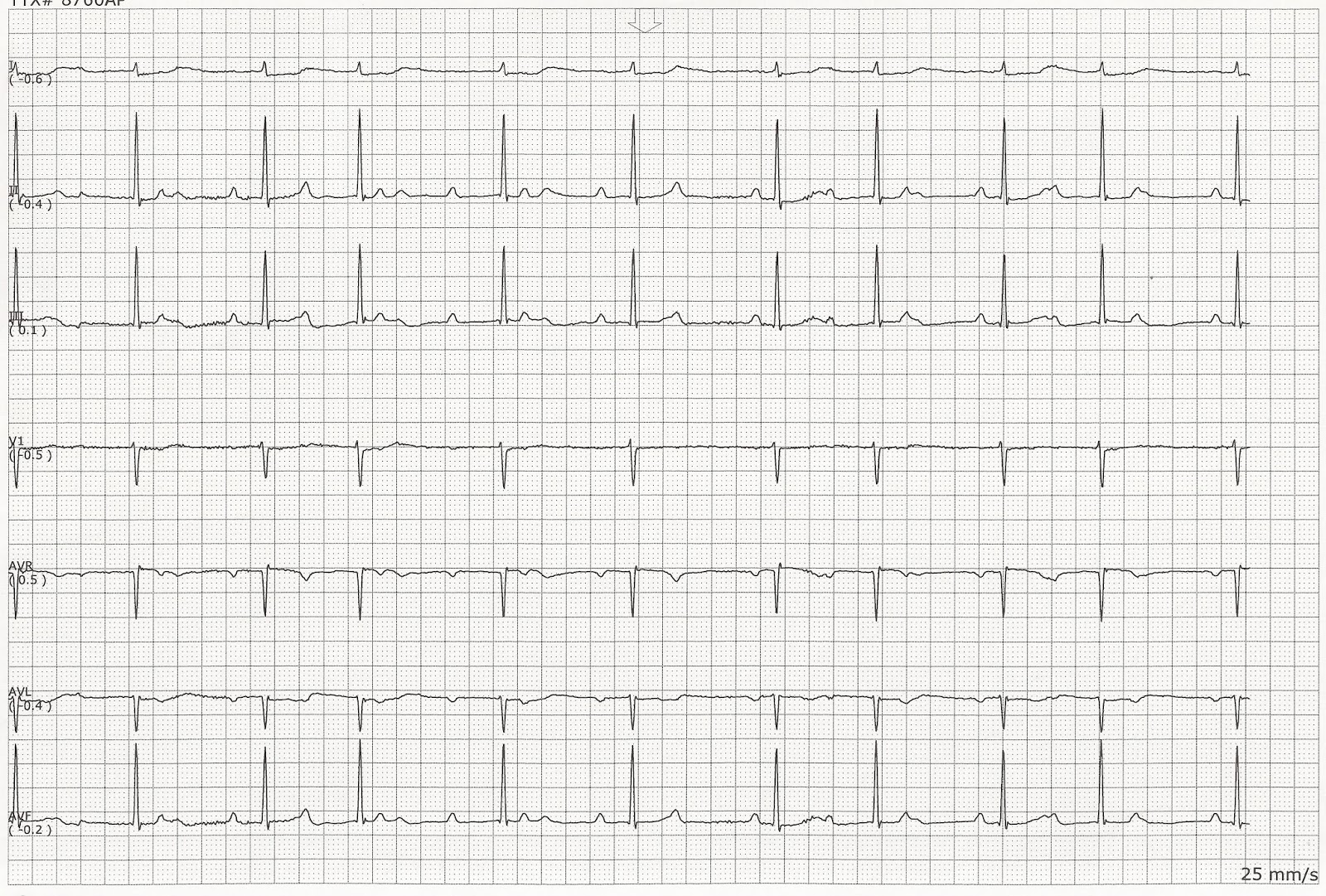 Complete heart block.