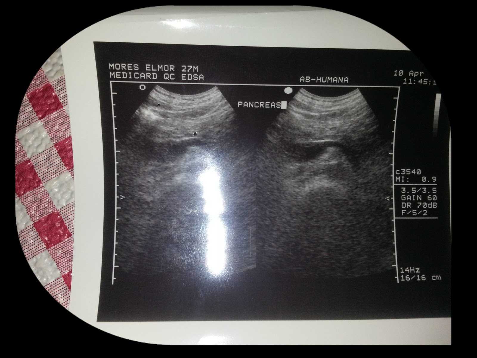 POTTERmoi: ULTRASOUND RESULT ON WHOLE ABDOMEN
