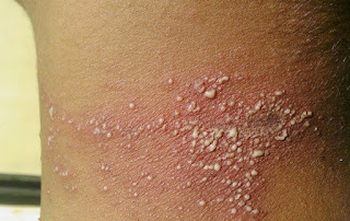 Foto Bahaya Penyakit Dompo Dan Cara alami dan ampuh Mengobatinya Herpes