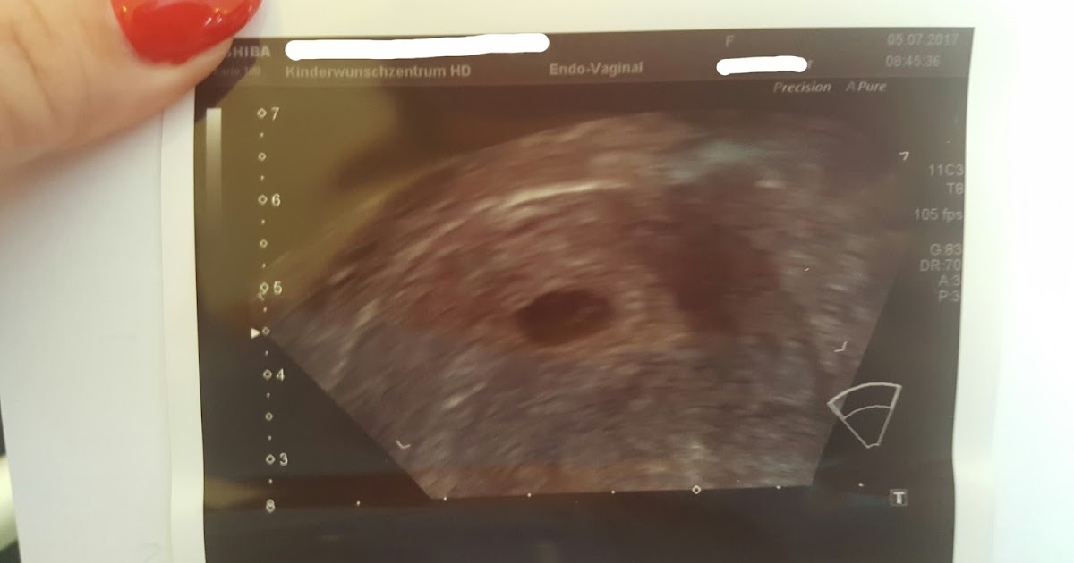 Der Kinderwunsch 6. SSW