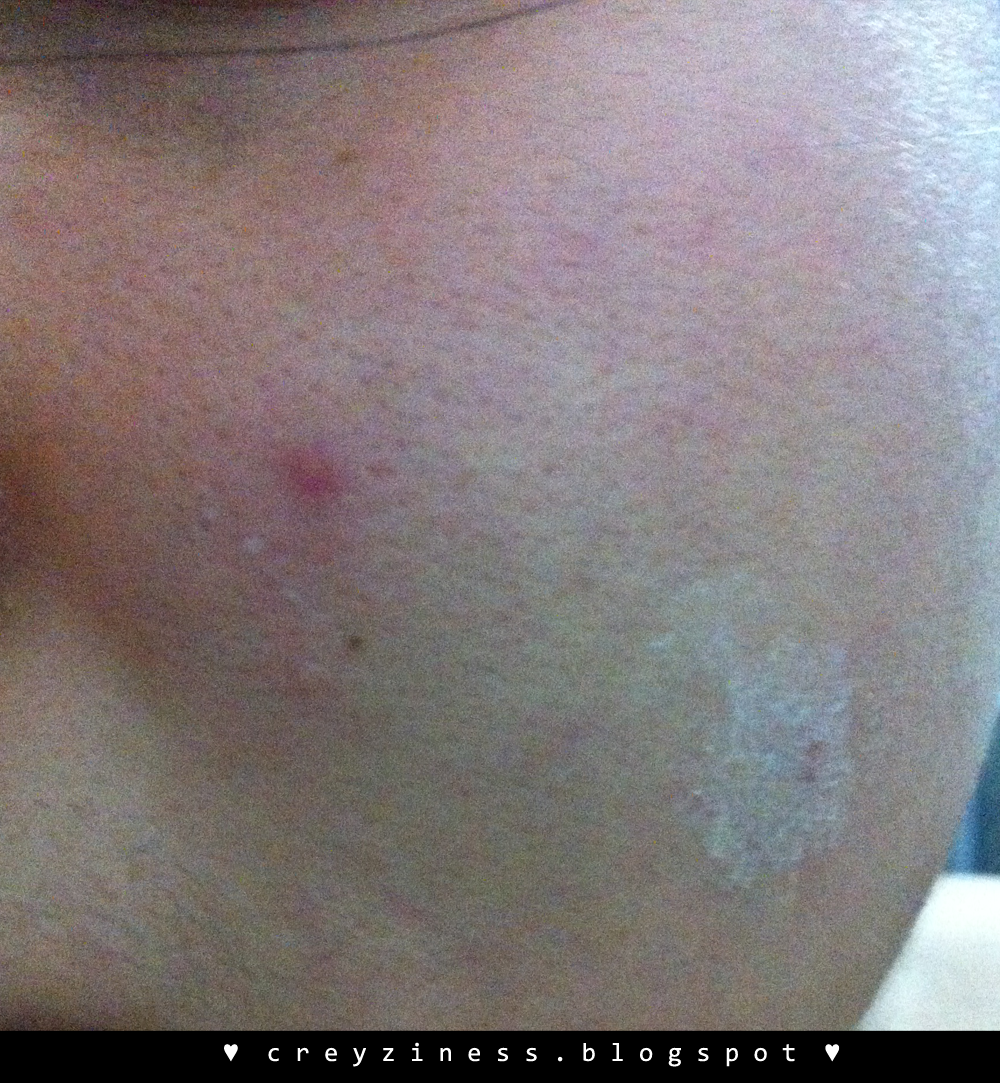 katialis cream for pimples