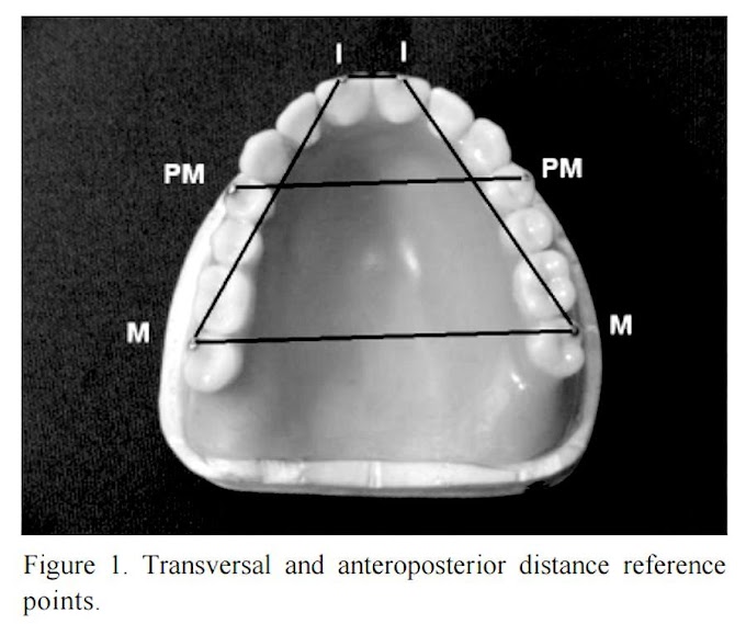 PDF: Effect of water storage on tooth displacement in maxillary complete dentures