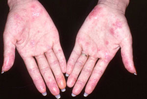 rashes on the hands