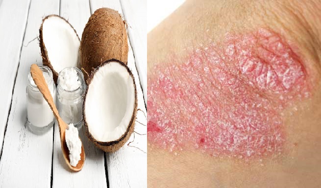 soigner un eczéma naturellement soigner un eczéma naturellement