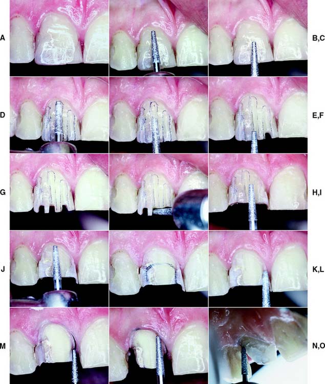 Odontology Student Prosthodontics The MetalCeramic Crown Preparation