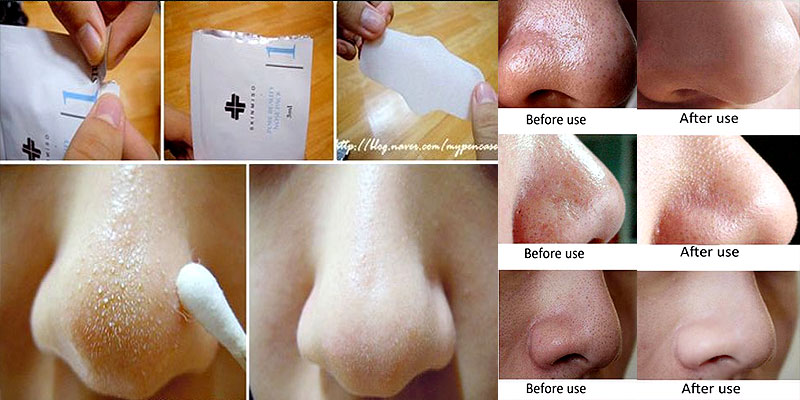 How To Remove Tons Of Blackheads & Whiteheads Instantly! 