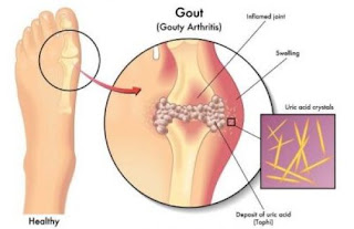 Resep Obat Asam Urat Tradisional Dari Tumbuhan, Apa Nama Obat Untuk Asam Urat?, Bahaya Penyakit Asam Urat dan Obatnya