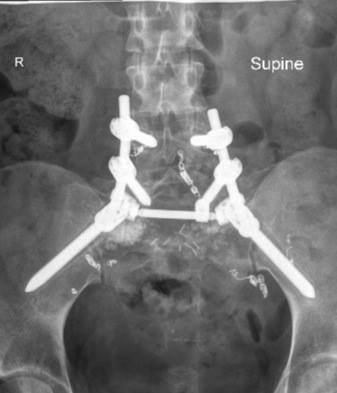 X-ray - when I had metal (aluminum) holding up my spine.