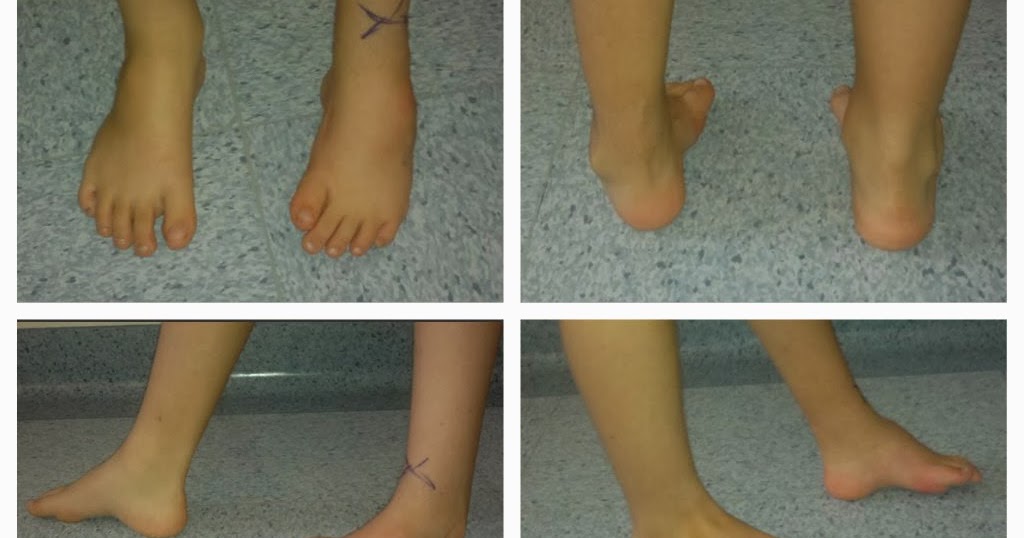scarpe a biscotto per piede torto