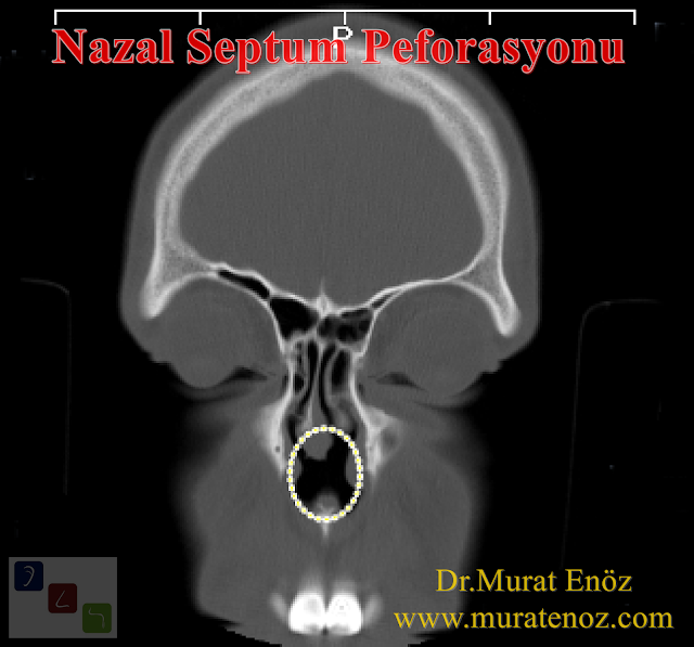 Nazal septum perforasyonun ameliyatının başarısı - Nazal septum perforasyonun çapı ameliyat başarısını olumsuz etkiliyor! - Burun septumundaki delik büyüdükçe ameliyatla tam kapanma oranı düşüyor - Nazal septum perforasyonu çapı - Burun duvarında delik olması