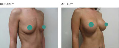 Antes e Depois Mamoplastia de Aumento Antes e Depois Mamoplastia de Aumento