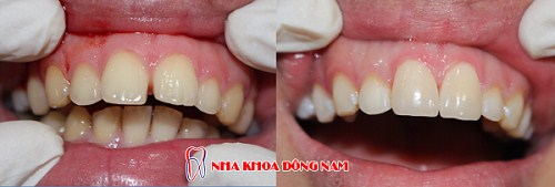 CHÌA 2 RĂNG CỬA ĐIỀU TRỊ CÁCH NÀO TỐT NHẤT -8