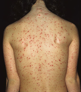 Obat Penyakit Herpes pada Punggung