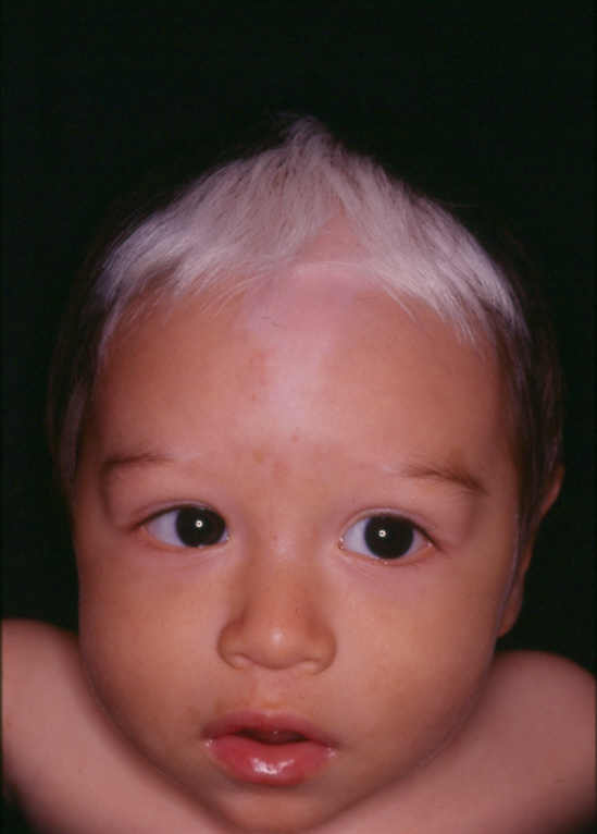 Заболевание белой кожи. Ваарденбурга синдром Ваарденбурга. Гипопигментация витилиго. Генетическое заболевание белая прядь волос.
