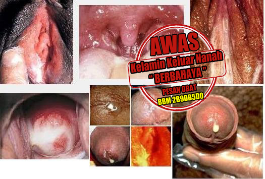 Obat Alami Penyembuh Kencing Sakit Keluar Nanah Obat Alami Penyembuh Kencing Sakit Keluar Nanah
