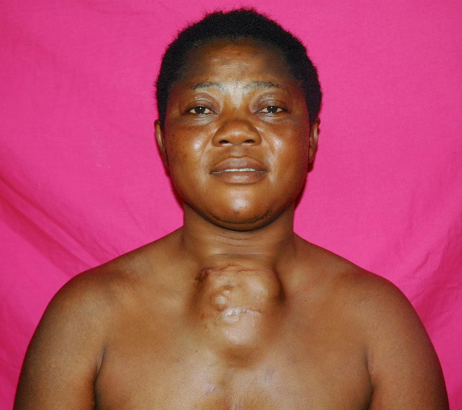 Earthwide Surgical Foundation STERNAL TUMOR