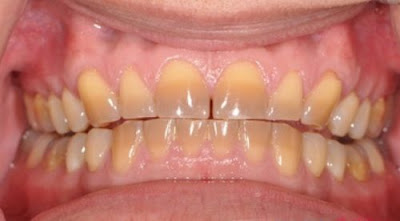 Răng bị sẩm màu nên làm gì?