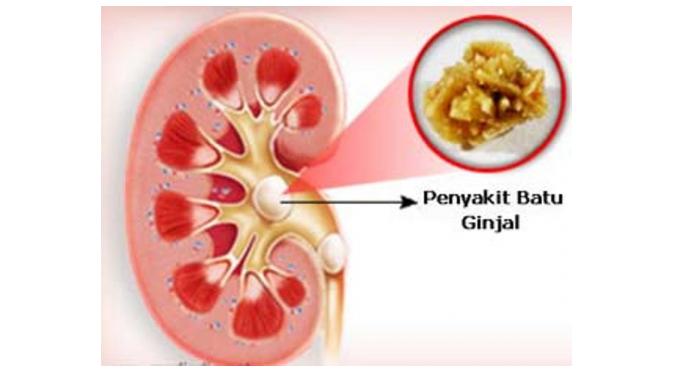 https://2.bp.blogspot.com/-ng3SGbCd6rg/WJ1rYXnasjI/AAAAAAAAAKw/vZCD66J1B8Epvrxz2FObXAVKLJcUaoRAgCLcB/s1600/Batu-Ginjal-ampuh.jpg