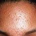 Treatment of Forehead Pimple and Acne at Home by Ayurvedic Method ( Red Bumps )
