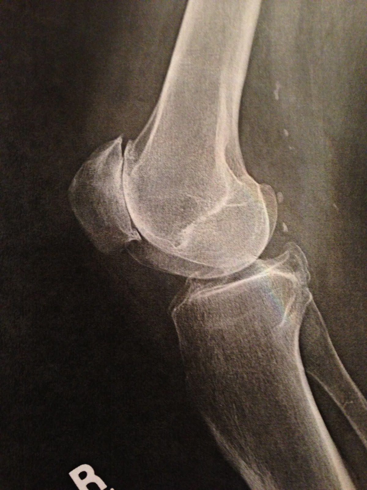 Рентген колена. Хондромаляция надколенника рентген. Лигаментоз коленного сустава рентген. Перелом надколенника рентген. Дольчатый надколенник рентген.