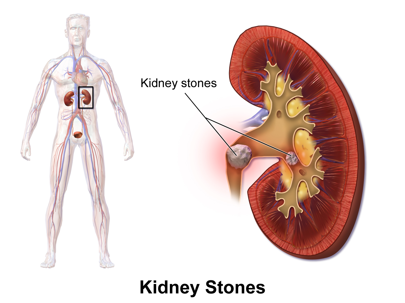 My brother once caught up with the pain of Kidney due to kidney stone. It was the first time I saw my elder brother screaming in the pain.
