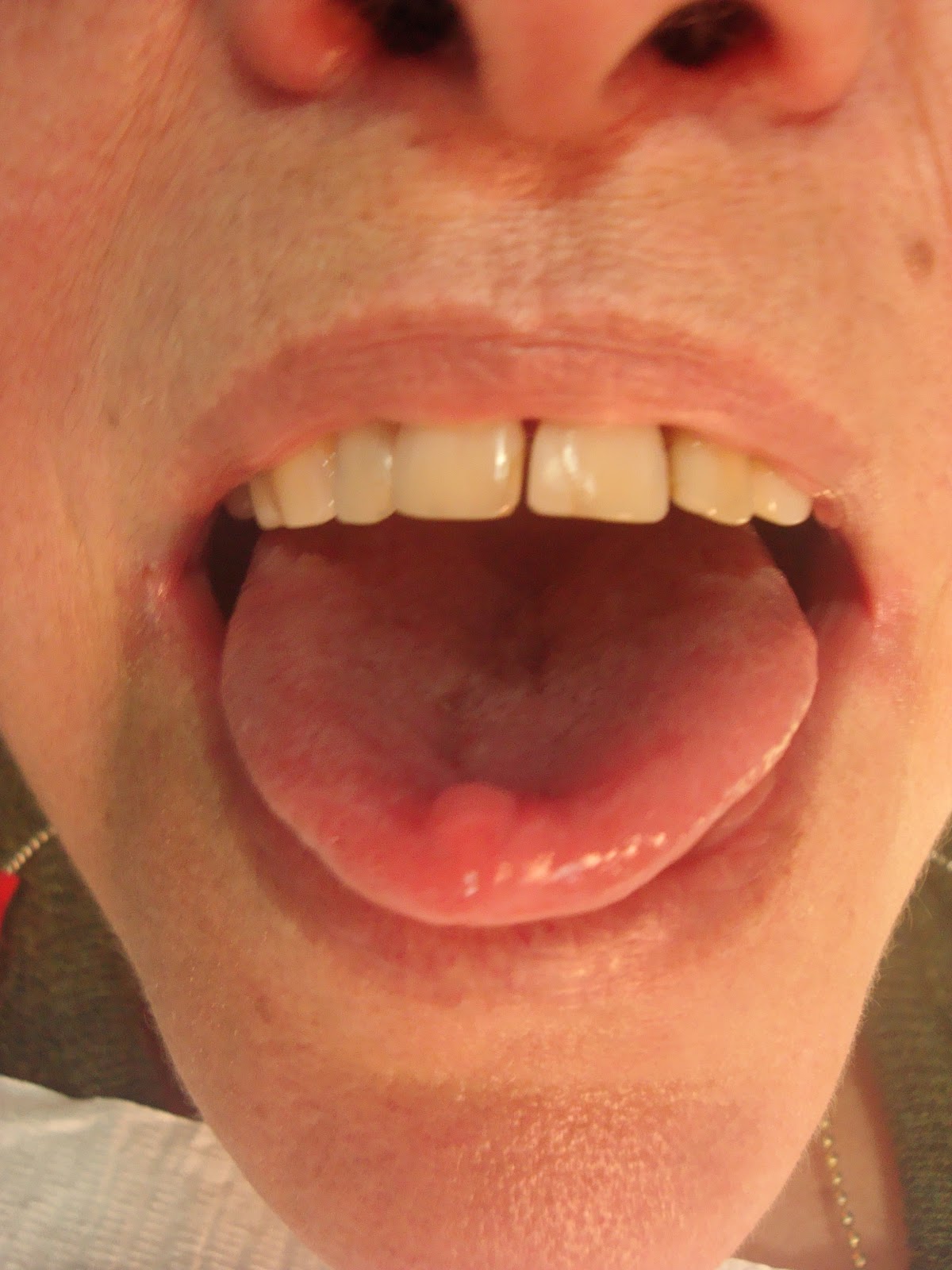 Fibroma Lingual CIRURGIA