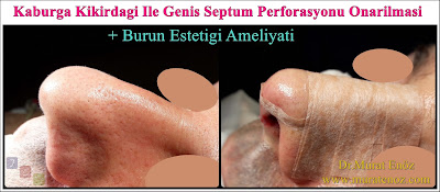 Erkek burun estetiği - Burun estetiği ameliyatı - Erkeklerde burun estetiği - Nose Job Surgery for Men - Male Rhinoplasty - Men's Rhinoplasty - Nose Reshaping for Men - Mens Rhinoplasty - Nose Job Rhinoplasty for Men - Best Rhinoplasty For Men Istanbul - Nose Aesthetic for Men - Male Nose Operation - Male Rhinoplasty Surgery in Istanbul - Male Rhinoplasty Surgery in Turkey - Male Nose Aesthetic Surgery - Rhinoplasty In Mens