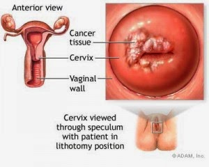 obat alami kanker Rahim stadium 4, obat kanker rahim, pengobatan kanker rahim