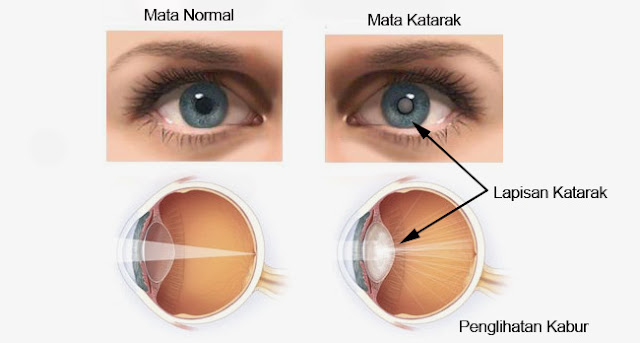 Penyebab dan cara mencegah katarak pada mata sejak dini