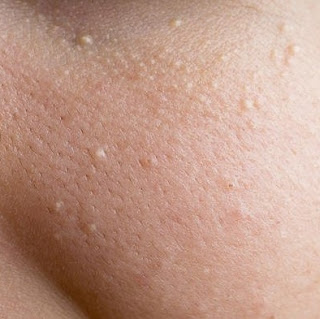 Acne Bumps Under Skin