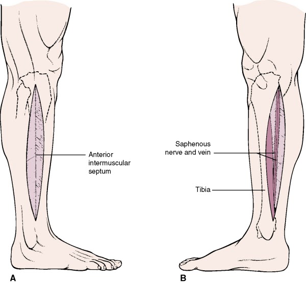 Longitudinal Incision Leg 骨科筆記: FASCIOTOMY